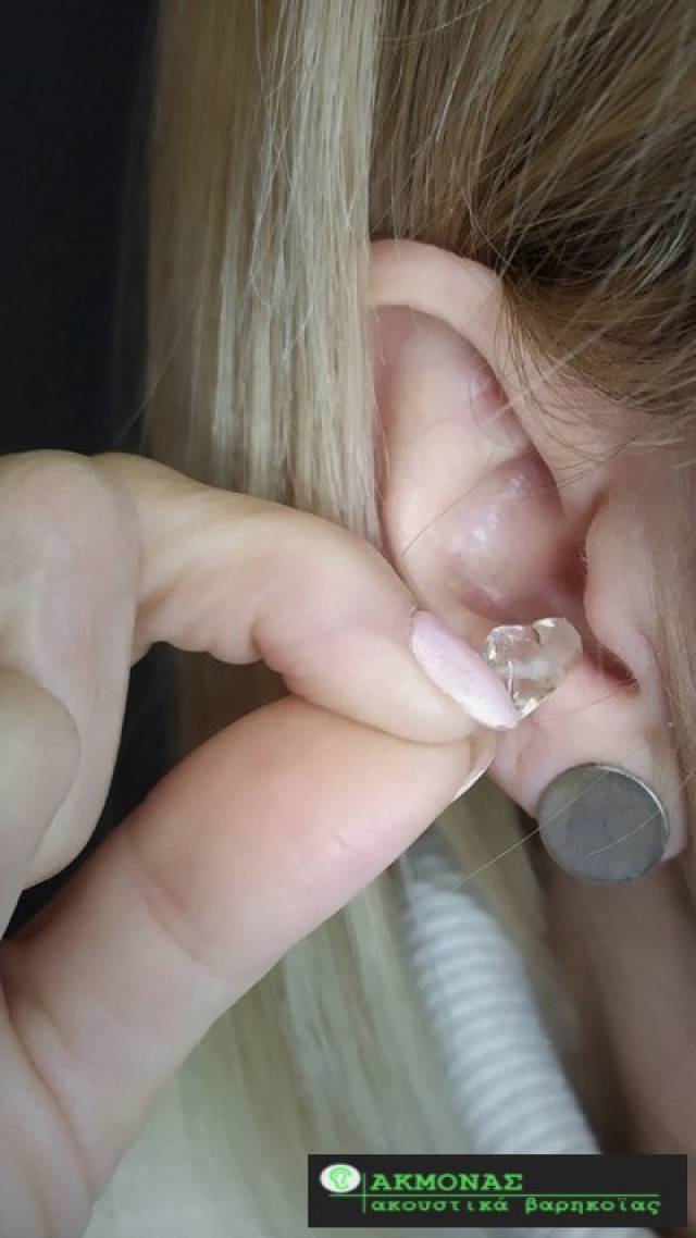Αόρατα ακουστικά βαρηκοΐας